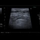 Acute diverticulitis on ultrasound: US - Ultrasound